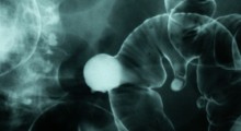 Colon_Polyp Colon_Polyp