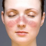 Lupus facial gracias a la wikipedia.org