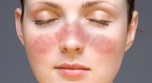 Lupus facial gracias a la wikipedia.org